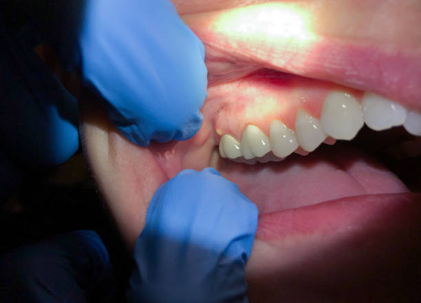 Best Emergency Root Canal Treatment in Kapn, LA